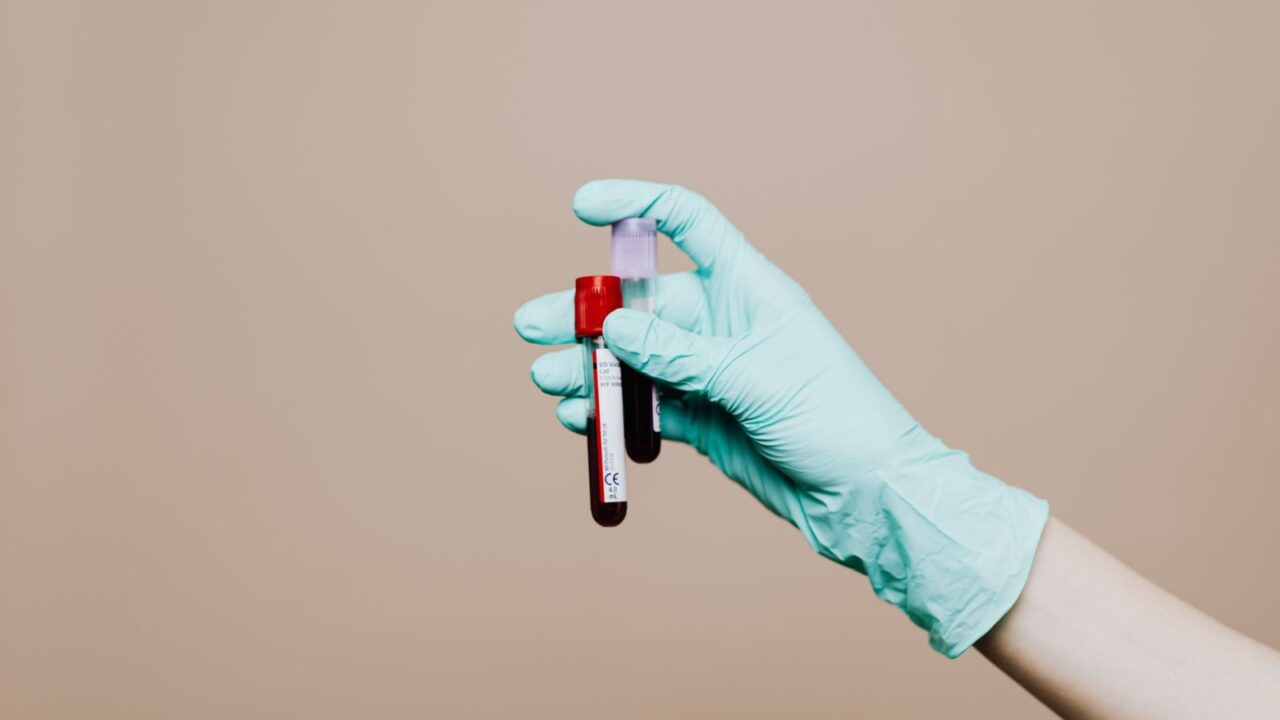 Iron Saturation Test (Transferrin Saturation): The Math and What It Means