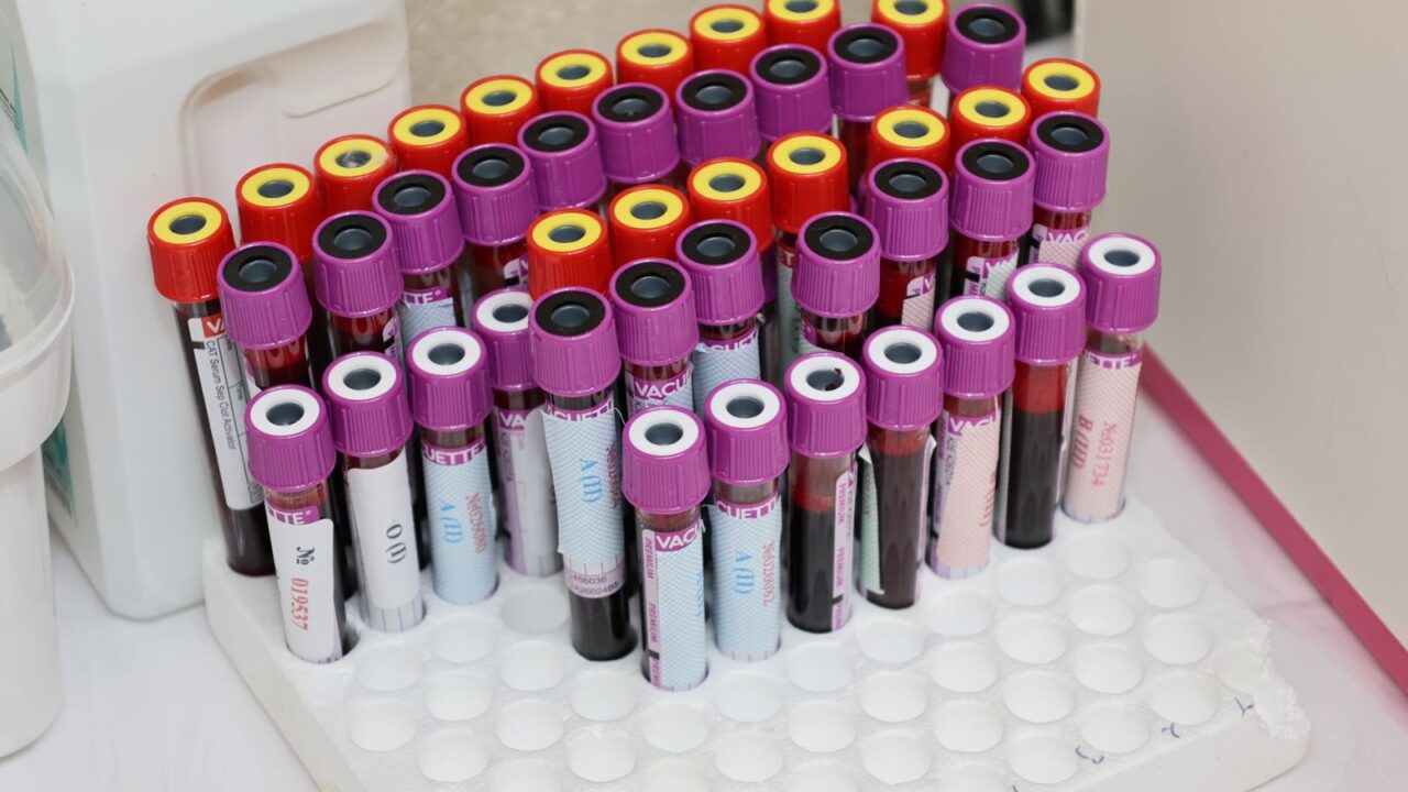 TB Skin Test vs Blood Test: How Each Works and Reading Results