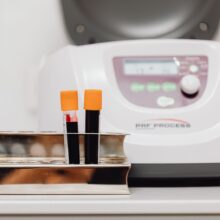 What Does a Low ESR Blood Test Mean? Causes and Cutoffs