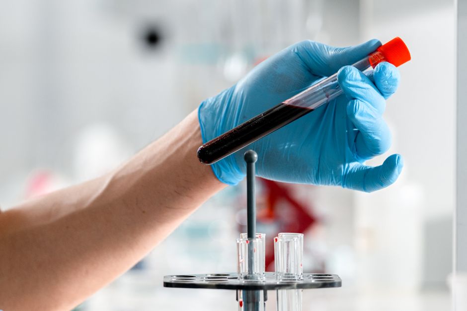 What Is Lymphocytes in a Blood Test? How to Read Your Immune System's  - blood analysis lab