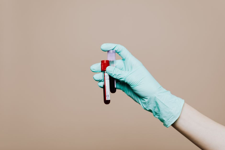 What Does Low Albumin Mean in a Blood Test? Causes and When to Worry - blood sample vial