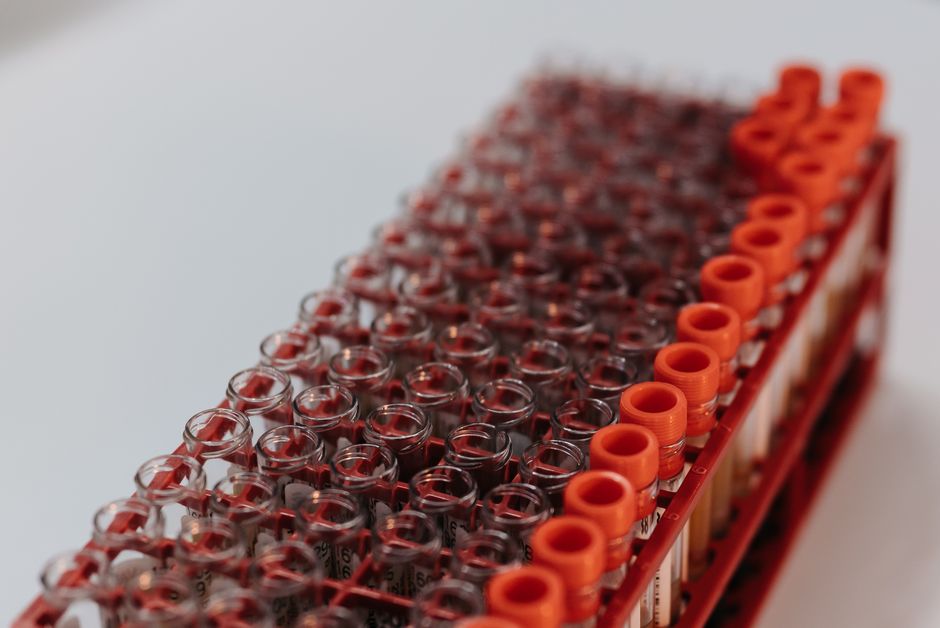 What Does High Globulin Mean in a Blood Test? Causes and Next Steps - blood sample vial