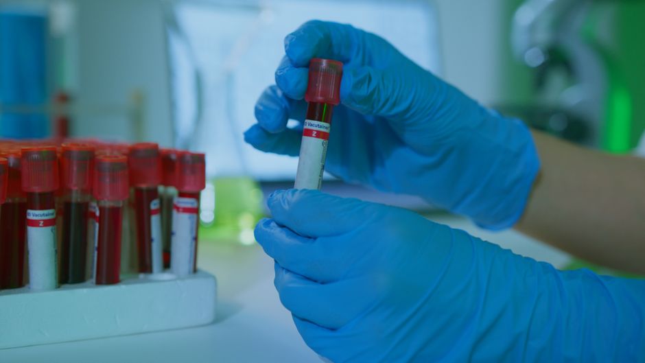 What Does a High CRP Blood Test Mean? Causes, Cutoffs & When to Worry - blood sample vial