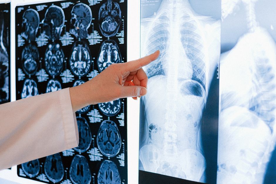 What Is BUN in a Blood Test? The Kidney Number That Moves for Surprisi - doctor reviewing scan