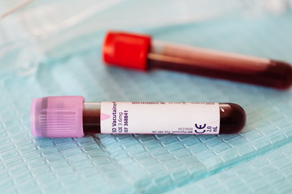 What Is an ANA Blood Test? Why a Positive Result Is Usually Not What Y - medical blood analysis