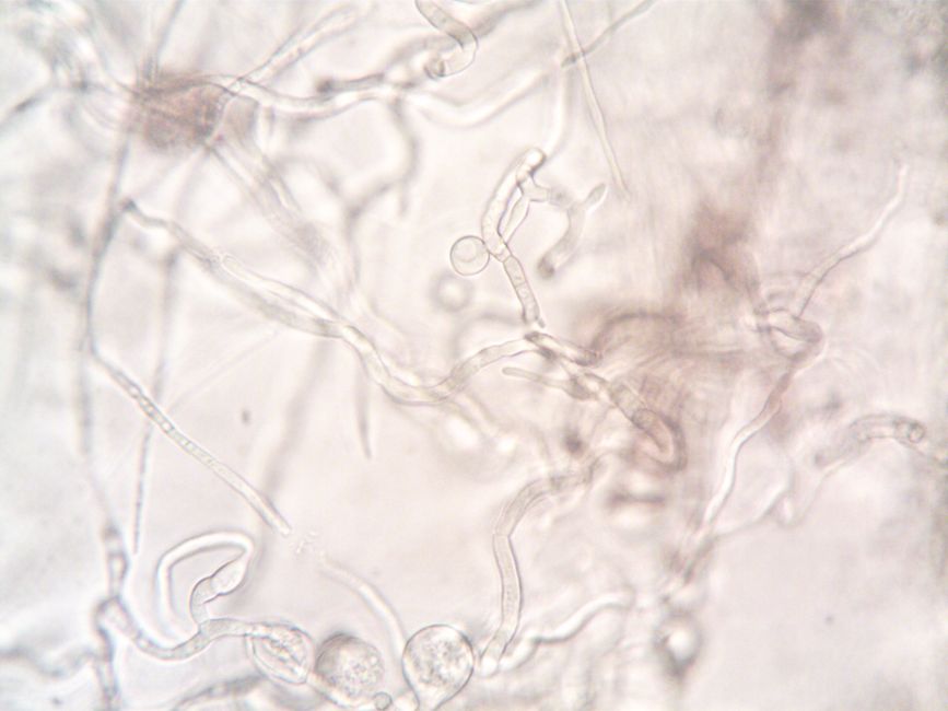 What Is NRBC in a Blood Test? The CBC Number That Should Read Zero - microscope blood cells