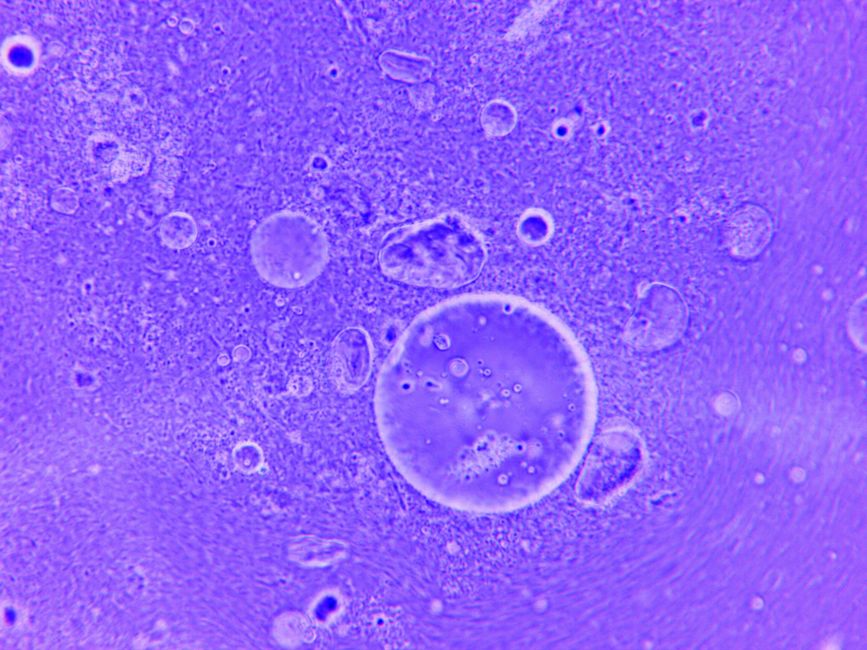What Is High MCV in a Blood Test? Causes, Symptoms, and What to Do - red blood cells microscope