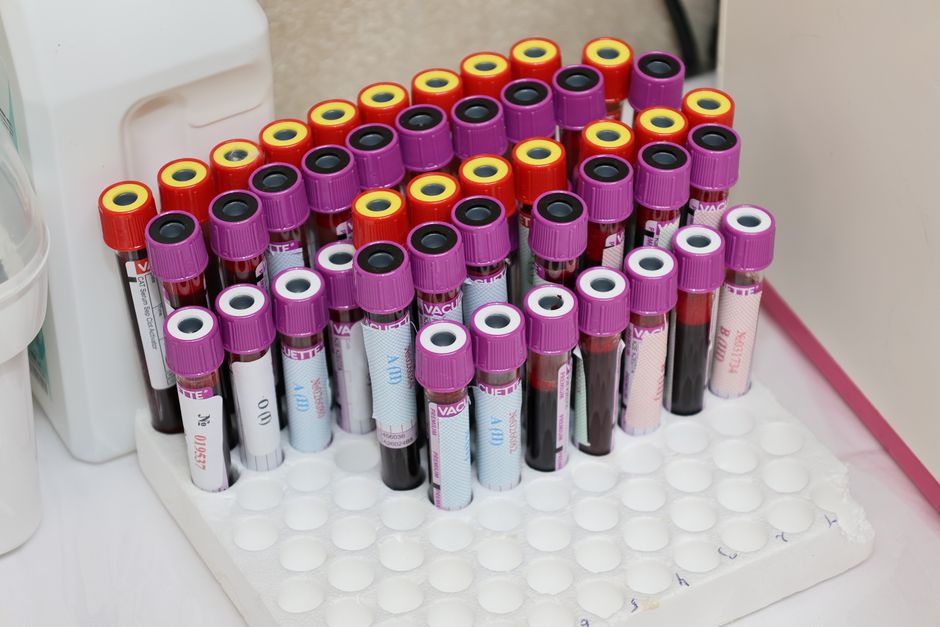What Is Globulin in a Blood Test? The Overlooked Protein That Tracks Y - test tubes blood samples