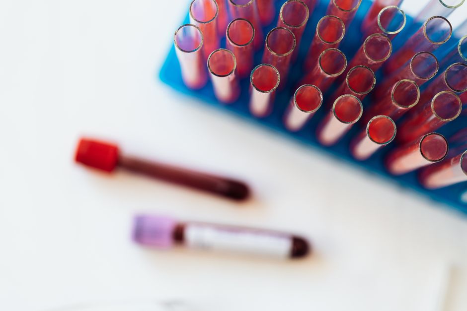 What Does High Glucose Mean in a Blood Test? Thresholds, Causes, and R - test tubes blood samples