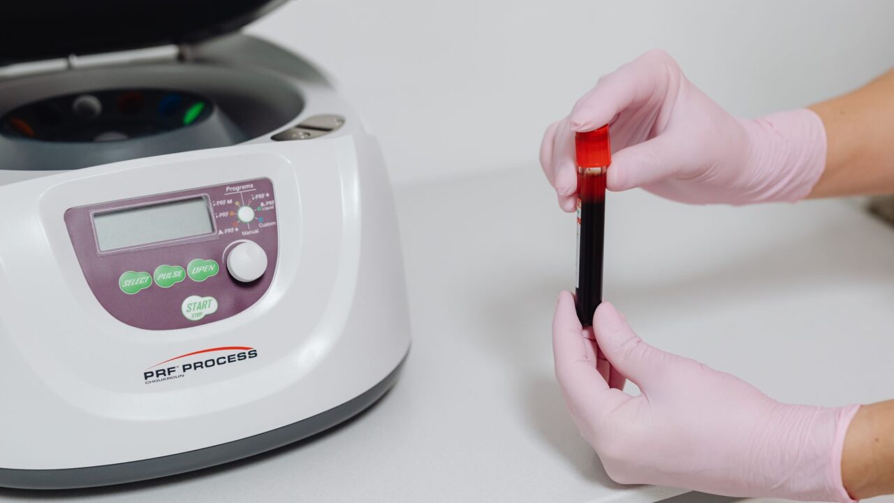 What Does a High INR Blood Test Mean? Cutoffs and Causes