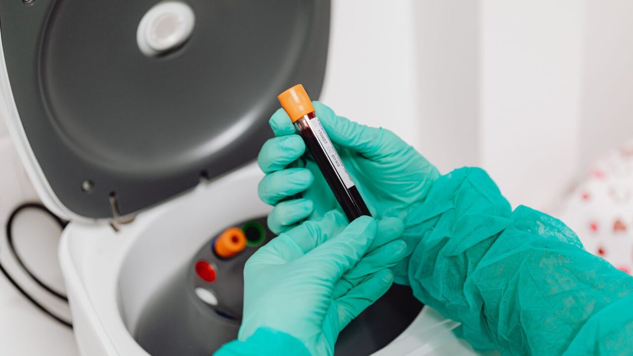 What Does a Low PLT Mean in a Blood Test? Low Platelet Count Explained