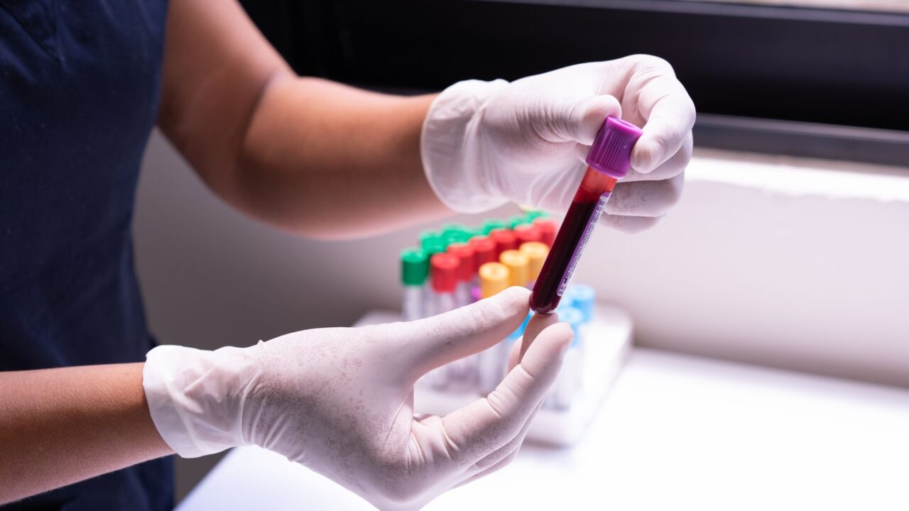 What Does High Triglycerides Mean in a Blood Test? Levels and Risks