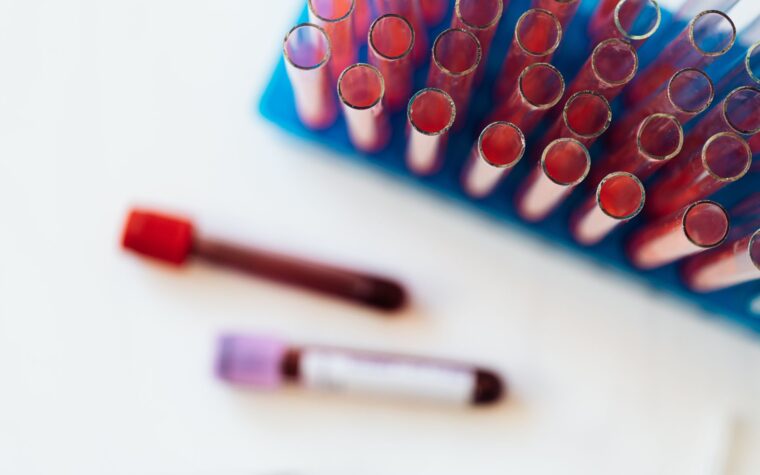 What Is a High MPV Blood Test? What an Elevated Result Really Means