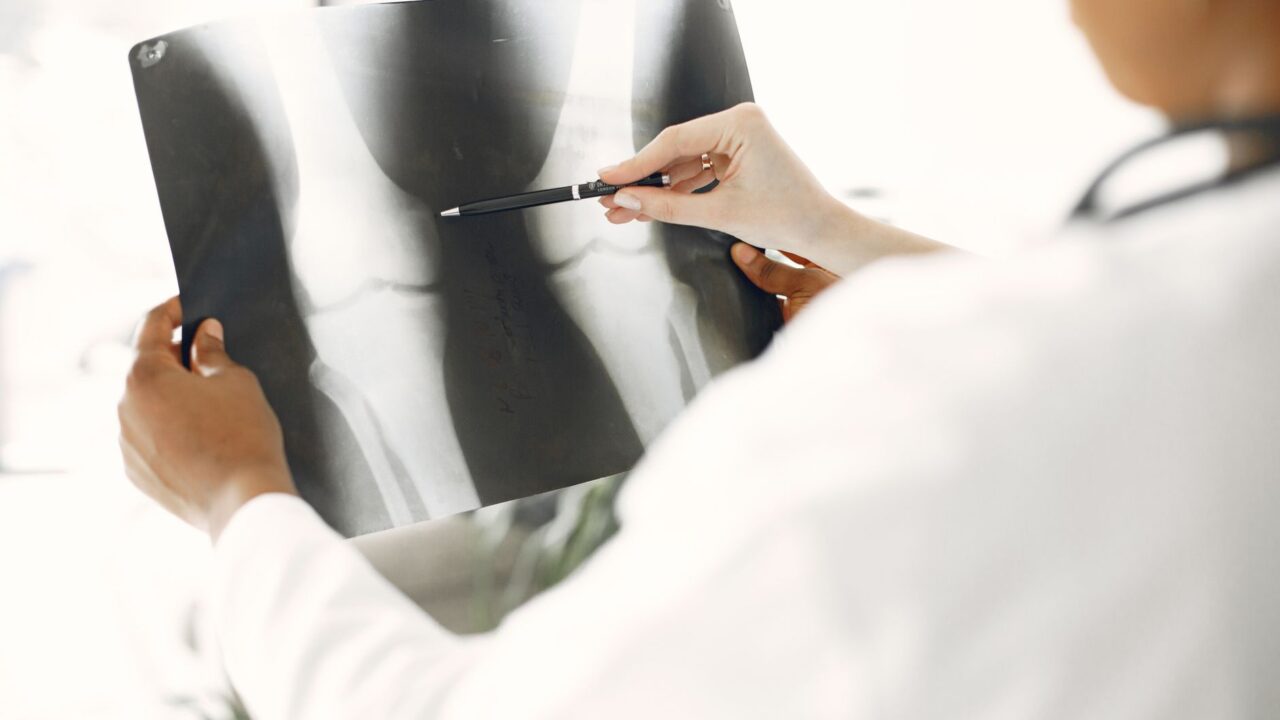 What Is Alkaline Phosphatase in a Blood Test? The Liver vs Bone Clue Most People Misread
