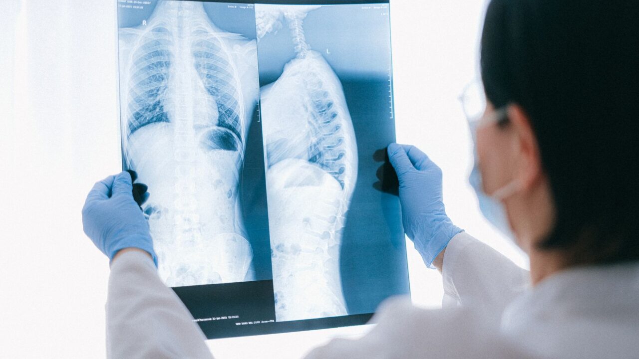 What Is AST and ALT in a Blood Test? The Two Liver Numbers and the Gap Between Them