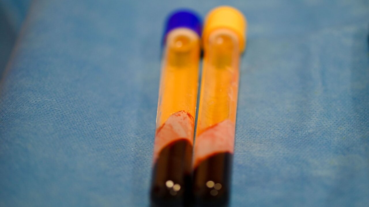 What Is MPV in a Blood Test? The Platelet Size Clue Most People Scroll Past